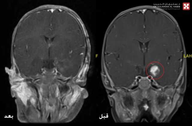 مستشفى الدكتور سليمان الحبيب بالخبر يُنهي معاناة رضيعة مع ورم بالدماغ تسبب بتشنجات صرعية حادة