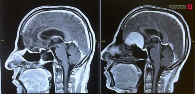 مستشفى الدكتور سليمان الحبيب بالخبر يستأصل ورماً ضخماً بقاع الجمجمة في عملية منظار استمرت 12 ساعة