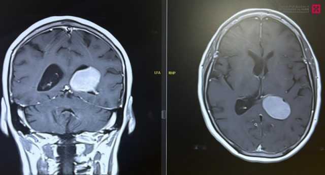مستشفى الدكتور سليمان الحبيب بالخبر ينهي معاناة 'سبعينية' مع ورم دماغي متزايد