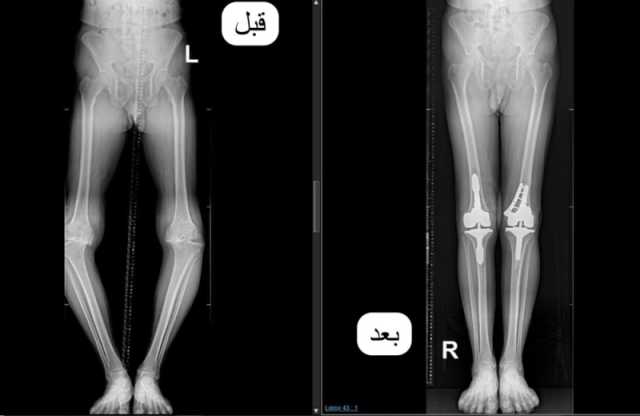 مستشفى الملك فهد الجامعي ينهي معاناة مريض من تشوهات متقدمة لمفصلي الركبة
