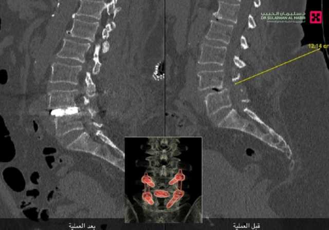 مستشفى الدكتور سليمان الحبيب بالخبر ينهي معاناة سبعينية وزنها أكثر من '100' كجم من انزلاق فقاري بتقنية متقدمة