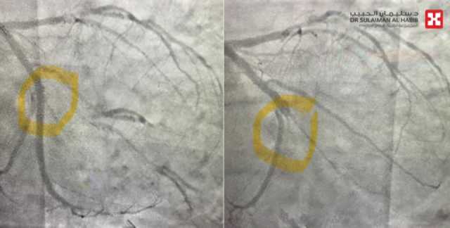 مستشفى الدكتور سليمان الحبيب بالخبر ينقذ حياة مريض توقف قلبه خلال '70' دقيقة