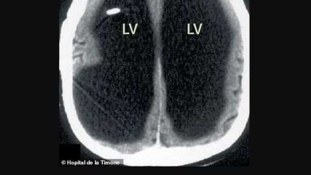 حالة غريبة لرجل يعيش 30 عاما بنصف دماغ فقط.. معدل ذكائه 75 درجة