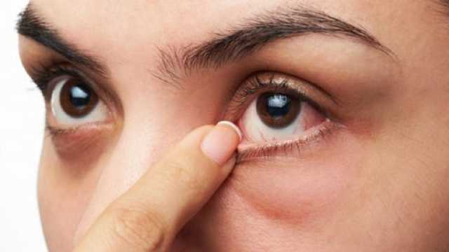 استشاري: جفاف العين قد يؤدي للإصابة بالعمى.. فيديو