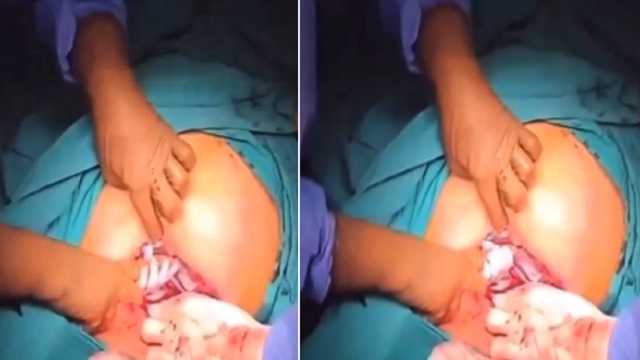 لقطة طريفة لمولود يمسك بيد الطبيب لحظة إخراجه من بطن أمه.. فيديو