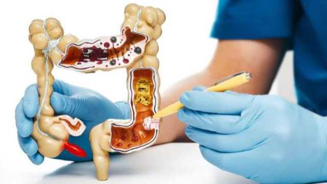 استشاري: علاج قرحة القولون يعتمد على السبب والعلاج المناسب