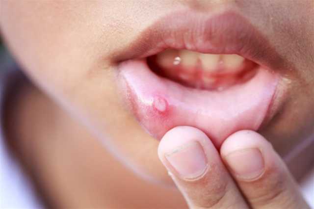 5 أعراض للإصابة بسرطان الفم.. احذر منها