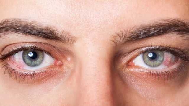 أعراض جفاف العين وطرق الوقاية منه خلال فصل الصيف