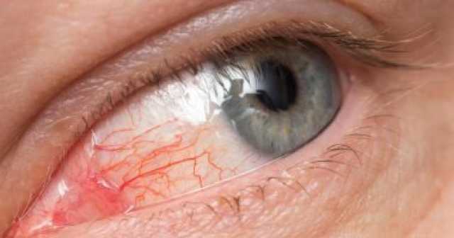 ما أسباب ظهور بقع حمراء في العين؟ تقرير يوضح صحة وطب