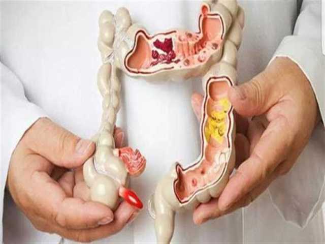 علامات مبكرة إذا ظهرت تدل عليك تدل على الإصابة بسرطان القولون.. احذرها لايف ستايل