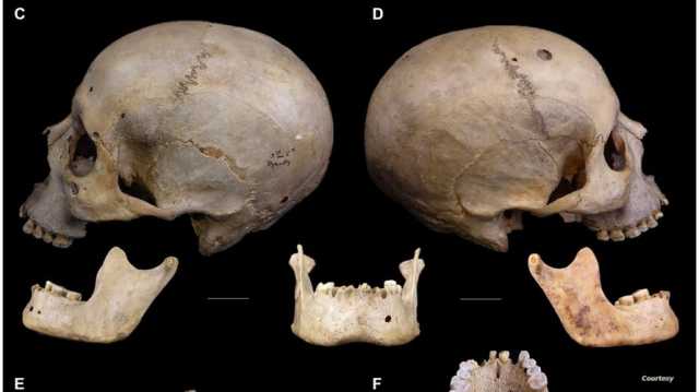 أول علاج بالتاريخ للسرطان.. جمجمة تكشف أسرار الطب عند قدماء المصريين