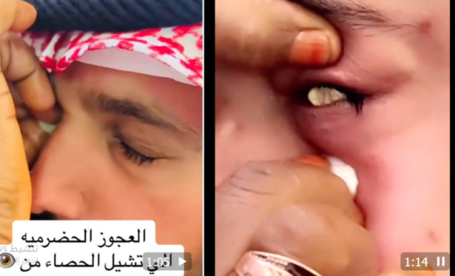 هل خبيرة أم ”ساحرة”؟.. عجوز حضرمية تثير الجدل بقدرات خارقة لإخراج ”الحصى من العيون” (فيديو)