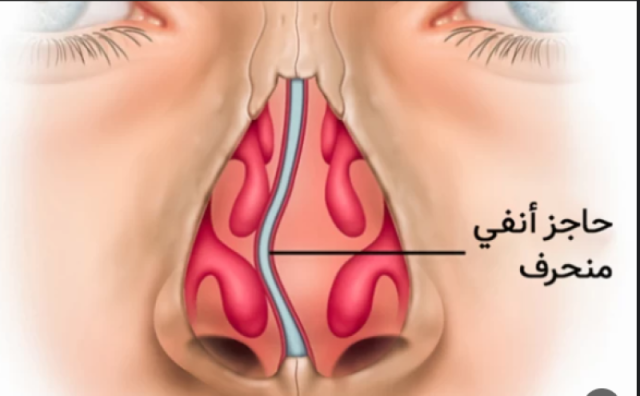 تعرف على الحاجز الأنفي وأعراضة وأسبابة وطرق علاجه