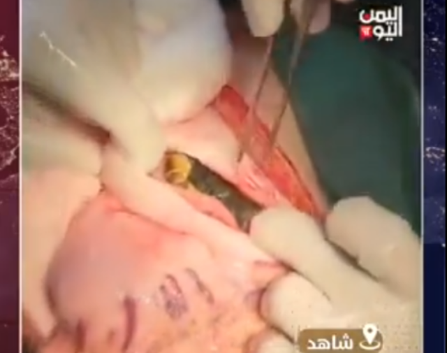 لن تصدق ما ستراه.. شاهد ماذا أخرج الأطباء من معدة مريض يمني أجريت له عملية جراحية في صنعاء؟