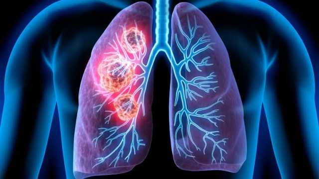 ألم الصدر وضيق التنفس... أعراض الإصابة بسرطان الرئة