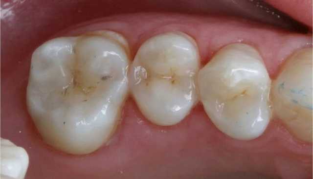6 علامات تدل على تعرض الأسنان للتسوس