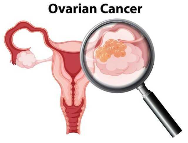 عقار جديد لعلاج سرطان المبيض.. أستاذ بـطب قصر العيني يعلن التفاصيل