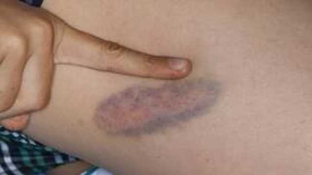 طبيبة تكشف سبب ظهور الكدمات (الأورام الدموية hematoma)