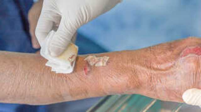 طفيليات مسببة لآفات جلدية 'مخيفة' قد تحمل سر كيفية منع الألم