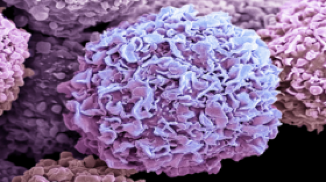 'الدخول في حالة سبات'.. آلية جديدة تضمن عدم عودة الإصابة بسرطان الثدي