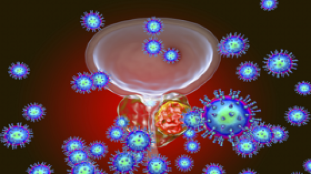 دراسة: تضاعف حالات سرطان البروستات حول العالم بحلول 2040