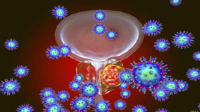 تحديد 'الدليل القاطع' على تطوّر وانتشار سرطان البروستات