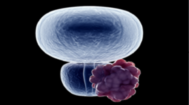 ابتكار 'يضيء' سرطان البروستات غير المرئي