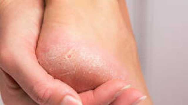 جفاف القدمين وتشققها قد يكون علامة إنذار عن مرض خطير