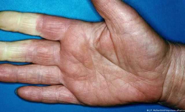متلازمة رينود: عندما يحوّل البرد الأصابع إلى جثث!