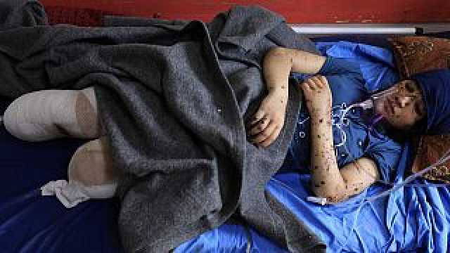 'لا أريد أطرافاً صناعية.. ازرعوا لي ساقي!' صرخة الأطفال ضحايا البتر في حرب غزة